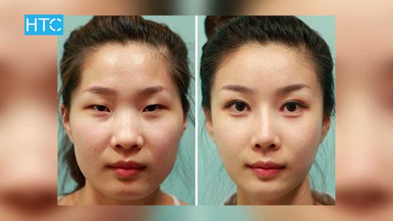 Что такое сангапури для глаз в косметологии. Сангапури. Операция сангапури. Сангапури блефаропластика. Сангапури до и после.
