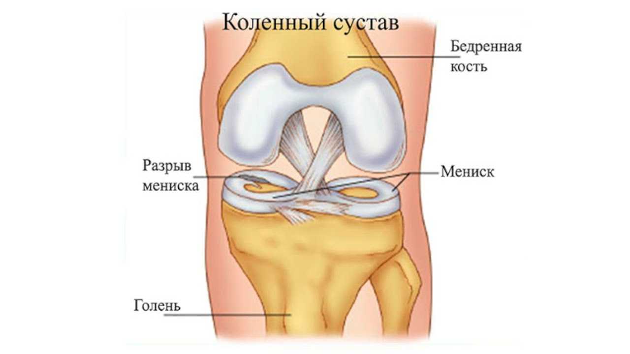 Лечение разрыва мениска коленного
