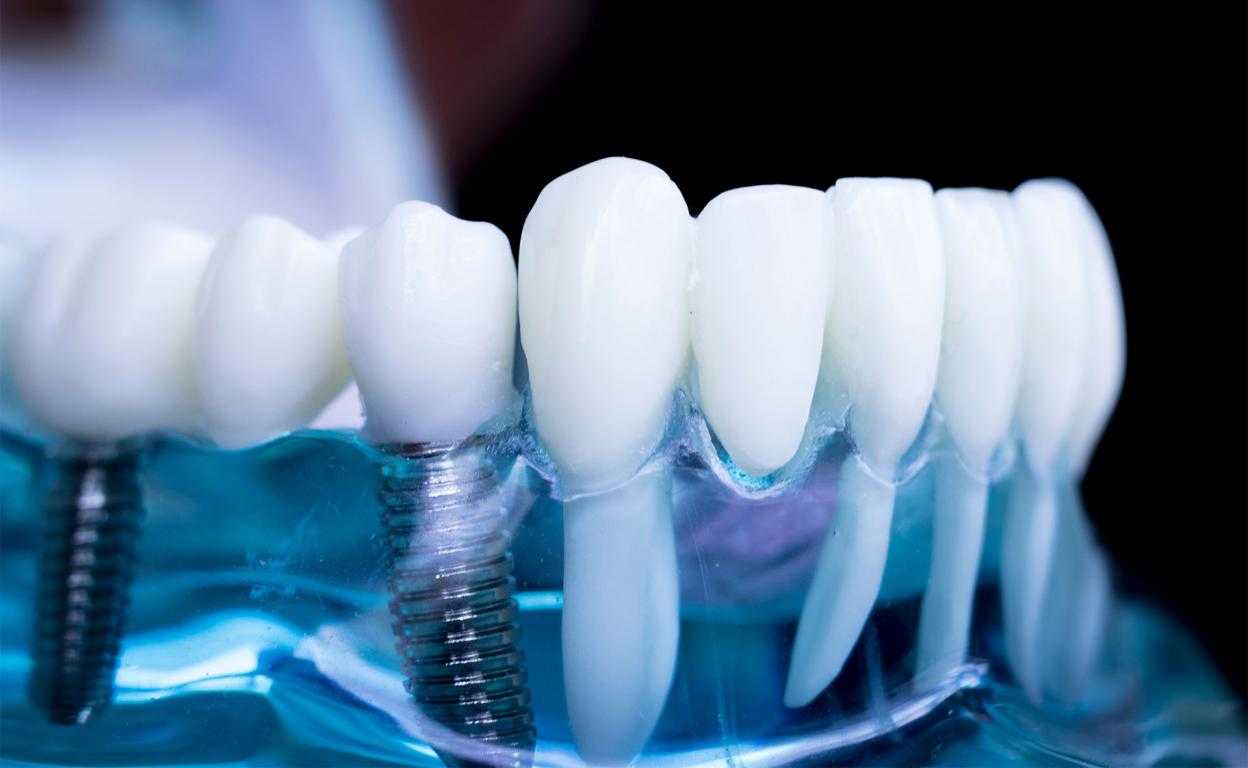 Se puede reparar una prótesis dental fija