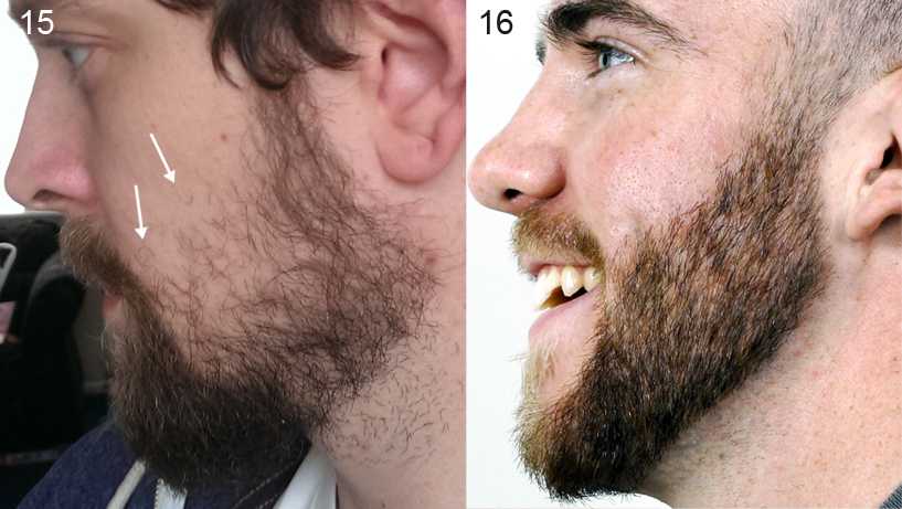 После бороды на коже